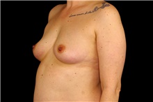 Breast Augmentation Before Photo by Landon Pryor, MD, FACS; Rockford, IL - Case 45166