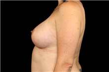 Breast Augmentation After Photo by Landon Pryor, MD, FACS; Rockford, IL - Case 45166