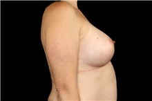 Breast Augmentation After Photo by Landon Pryor, MD, FACS; Rockford, IL - Case 45166