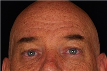 Eyelid Surgery Before Photo by Landon Pryor, MD, FACS; Rockford, IL - Case 45168