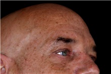 Eyelid Surgery After Photo by Landon Pryor, MD, FACS; Rockford, IL - Case 45168