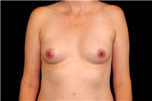 Breast Augmentation Before Photo by Landon Pryor, MD, FACS; Rockford, IL - Case 45169