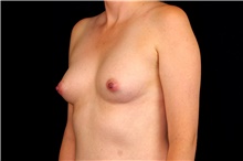 Breast Augmentation Before Photo by Landon Pryor, MD, FACS; Rockford, IL - Case 45169