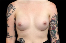 Breast Augmentation After Photo by Landon Pryor, MD, FACS; Rockford, IL - Case 45170