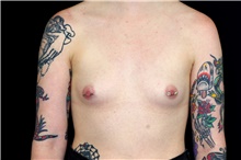 Breast Augmentation Before Photo by Landon Pryor, MD, FACS; Rockford, IL - Case 45170