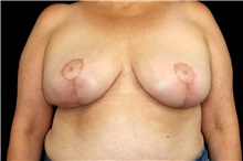 Breast Implant Revision After Photo by Landon Pryor, MD, FACS; Rockford, IL - Case 45172
