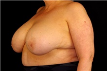 Breast Implant Revision Before Photo by Landon Pryor, MD, FACS; Rockford, IL - Case 45172