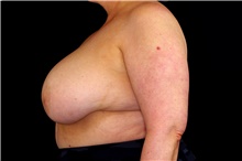 Breast Implant Revision Before Photo by Landon Pryor, MD, FACS; Rockford, IL - Case 45172