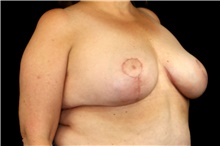 Breast Implant Revision After Photo by Landon Pryor, MD, FACS; Rockford, IL - Case 45172