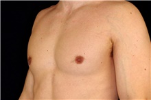 Male Breast Reduction After Photo by Landon Pryor, MD, FACS; Rockford, IL - Case 45173
