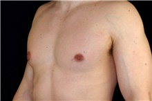 Male Breast Reduction Before Photo by Landon Pryor, MD, FACS; Rockford, IL - Case 45173