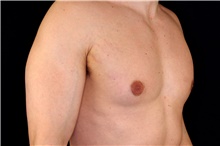 Male Breast Reduction Before Photo by Landon Pryor, MD, FACS; Rockford, IL - Case 45173