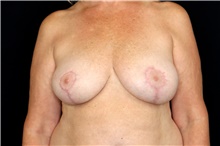 Breast Implant Removal After Photo by Landon Pryor, MD, FACS; Rockford, IL - Case 45176