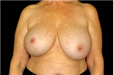 Breast Implant Removal Before Photo by Landon Pryor, MD, FACS; Rockford, IL - Case 45176