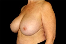 Breast Implant Removal Before Photo by Landon Pryor, MD, FACS; Rockford, IL - Case 45176