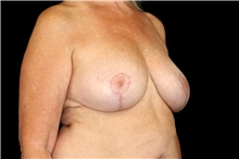 Breast Implant Removal After Photo by Landon Pryor, MD, FACS; Rockford, IL - Case 45176