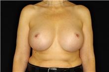 Breast Implant Removal Before Photo by Landon Pryor, MD, FACS; Rockford, IL - Case 45178