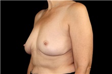 Breast Implant Removal After Photo by Landon Pryor, MD, FACS; Rockford, IL - Case 45178