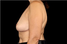 Breast Implant Removal After Photo by Landon Pryor, MD, FACS; Rockford, IL - Case 45178