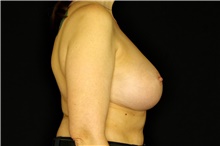 Breast Implant Removal Before Photo by Landon Pryor, MD, FACS; Rockford, IL - Case 45178