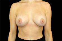 Breast Implant Removal Before Photo by Landon Pryor, MD, FACS; Rockford, IL - Case 45179