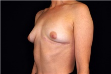 Breast Implant Removal After Photo by Landon Pryor, MD, FACS; Rockford, IL - Case 45179