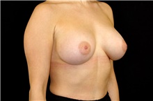 Breast Implant Removal Before Photo by Landon Pryor, MD, FACS; Rockford, IL - Case 45179