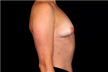 Breast Implant Removal After Photo by Landon Pryor, MD, FACS; Rockford, IL - Case 45179