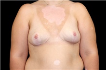 Breast Implant Removal After Photo by Landon Pryor, MD, FACS; Rockford, IL - Case 45180