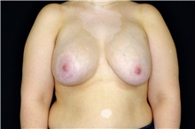 Breast Implant Removal Before Photo by Landon Pryor, MD, FACS; Rockford, IL - Case 45180