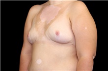 Breast Implant Removal After Photo by Landon Pryor, MD, FACS; Rockford, IL - Case 45180