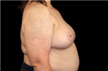 Breast Implant Removal After Photo by Landon Pryor, MD, FACS; Rockford, IL - Case 45181
