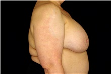 Breast Implant Removal Before Photo by Landon Pryor, MD, FACS; Rockford, IL - Case 45181