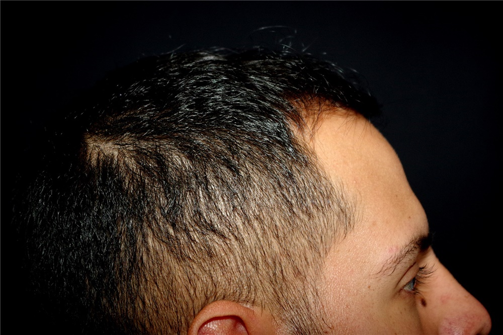 Hair Transplant Before and After Photos by Landon Pryor, MD, FACS;  Rockford, IL - Case 45183 | ASPS
