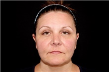 Thread Lift After Photo by Landon Pryor, MD, FACS; Rockford, IL - Case 45185