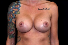 Breast Augmentation After Photo by Landon Pryor, MD, FACS; Rockford, IL - Case 45190