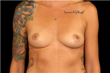 Breast Augmentation Before Photo by Landon Pryor, MD, FACS; Rockford, IL - Case 45190