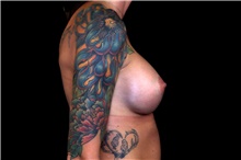 Breast Augmentation After Photo by Landon Pryor, MD, FACS; Rockford, IL - Case 45190
