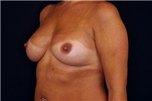 Breast Implant Revision Before Photo by Landon Pryor, MD, FACS; Rockford, IL - Case 45191