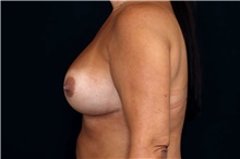 Breast Implant Revision After Photo by Landon Pryor, MD, FACS; Rockford, IL - Case 45191