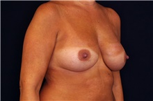 Breast Implant Revision Before Photo by Landon Pryor, MD, FACS; Rockford, IL - Case 45191