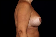 Breast Implant Revision After Photo by Landon Pryor, MD, FACS; Rockford, IL - Case 45191