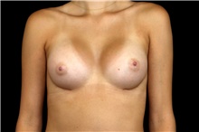 Breast Augmentation After Photo by Landon Pryor, MD, FACS; Rockford, IL - Case 45192