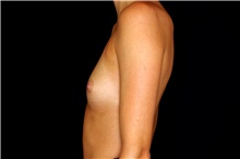 Breast Augmentation Before Photo by Landon Pryor, MD, FACS; Rockford, IL - Case 45192