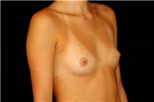 Breast Augmentation Before Photo by Landon Pryor, MD, FACS; Rockford, IL - Case 45192