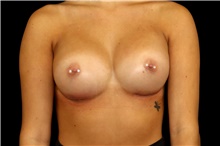 Breast Augmentation After Photo by Landon Pryor, MD, FACS; Rockford, IL - Case 45193
