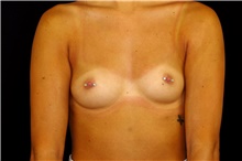 Breast Augmentation Before Photo by Landon Pryor, MD, FACS; Rockford, IL - Case 45193
