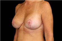 Breast Implant Revision After Photo by Landon Pryor, MD, FACS; Rockford, IL - Case 45194