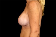 Breast Implant Revision After Photo by Landon Pryor, MD, FACS; Rockford, IL - Case 45194