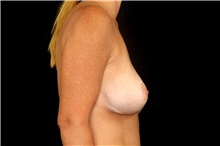 Breast Implant Revision Before Photo by Landon Pryor, MD, FACS; Rockford, IL - Case 45194